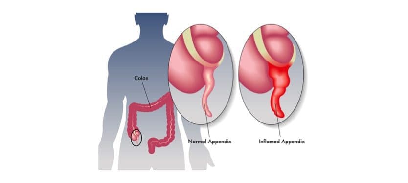 Appendicitis case report, ANCA vasculitis