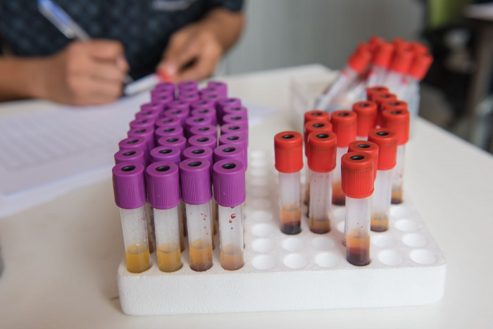 Lab Visits / ANCA Vasculitis News / Multiple blood samples in a collection tray at the lab.