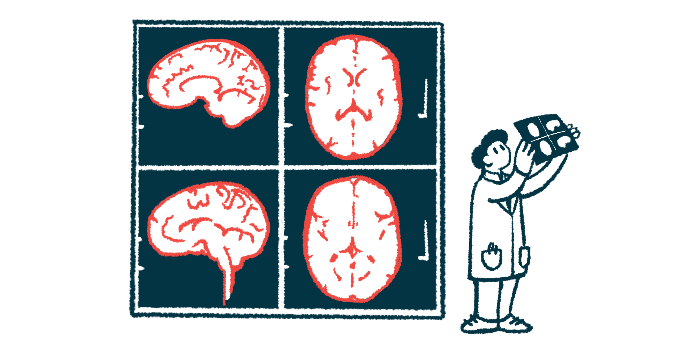 A clinician holds up a brain scan to review it alongside images of four brain scans illuminated on a wall.